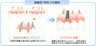 インプラント前歯