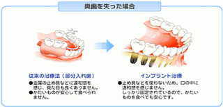 インプラント奥歯