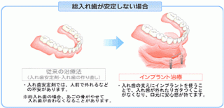 インプラント総入れ歯