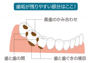 歯垢から歯石へ